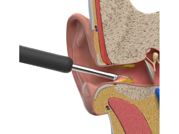 Schématisation du nettoyage d'un conduit auditif avec un nettoyeur d'oreille connecté